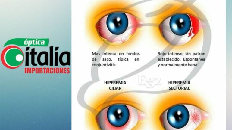 Ojo rojo: ¿cuándo es normal y cuándo hay que consultar?